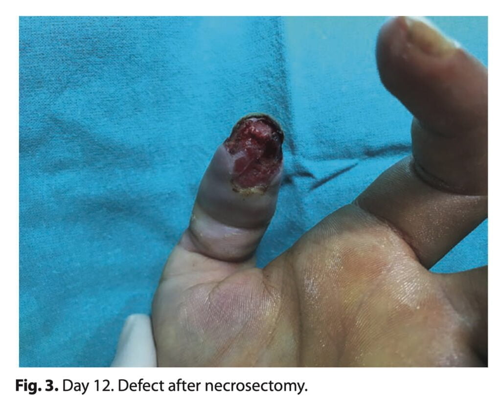 <strong>Finger necrosis due to mephedrone (case report)</strong>