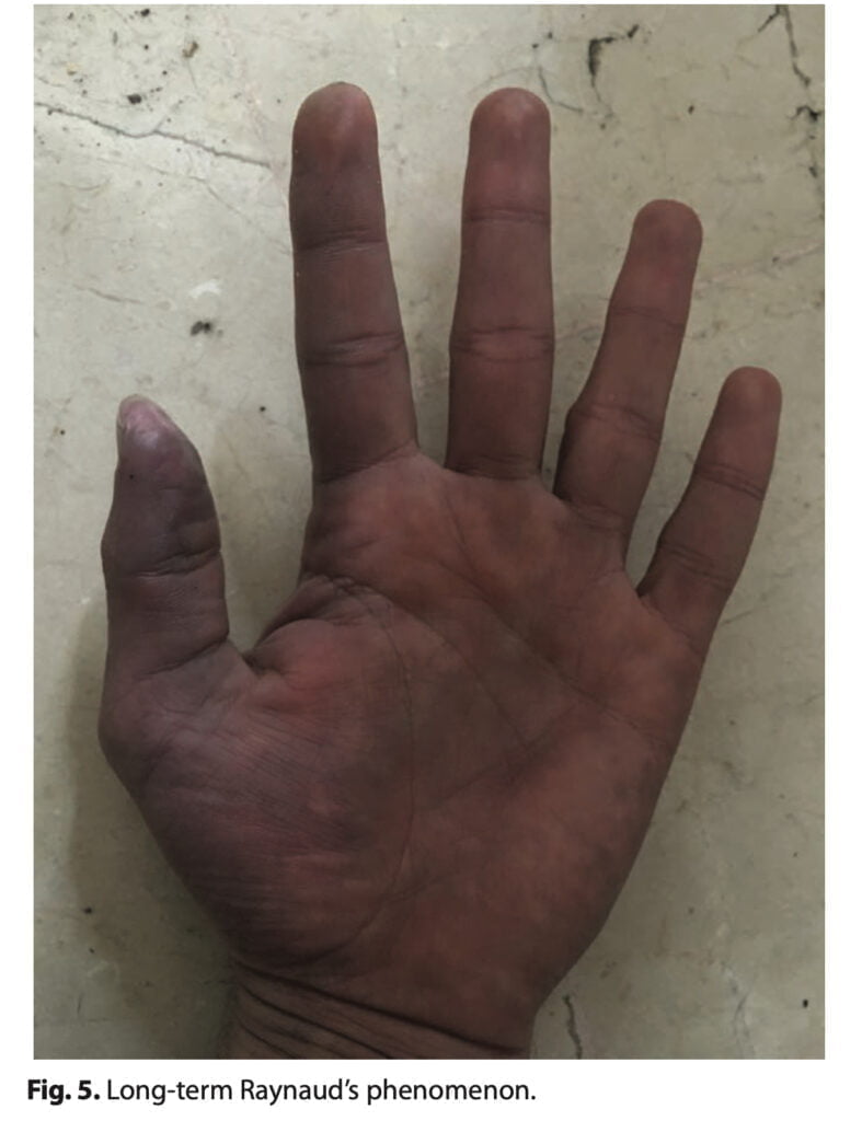 <strong>Finger necrosis due to mephedrone (case report)</strong>