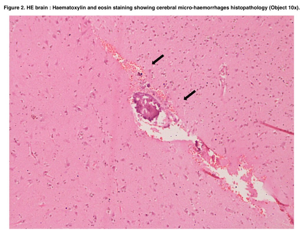 Death After Mephedrone Sex: Causes of death during MEPH sex